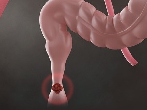  직장암 보다 위험한 결장암 재발 전이 수술후 부작용