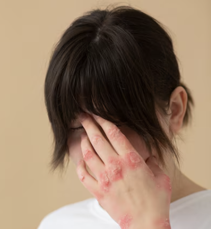 수두 증상 15