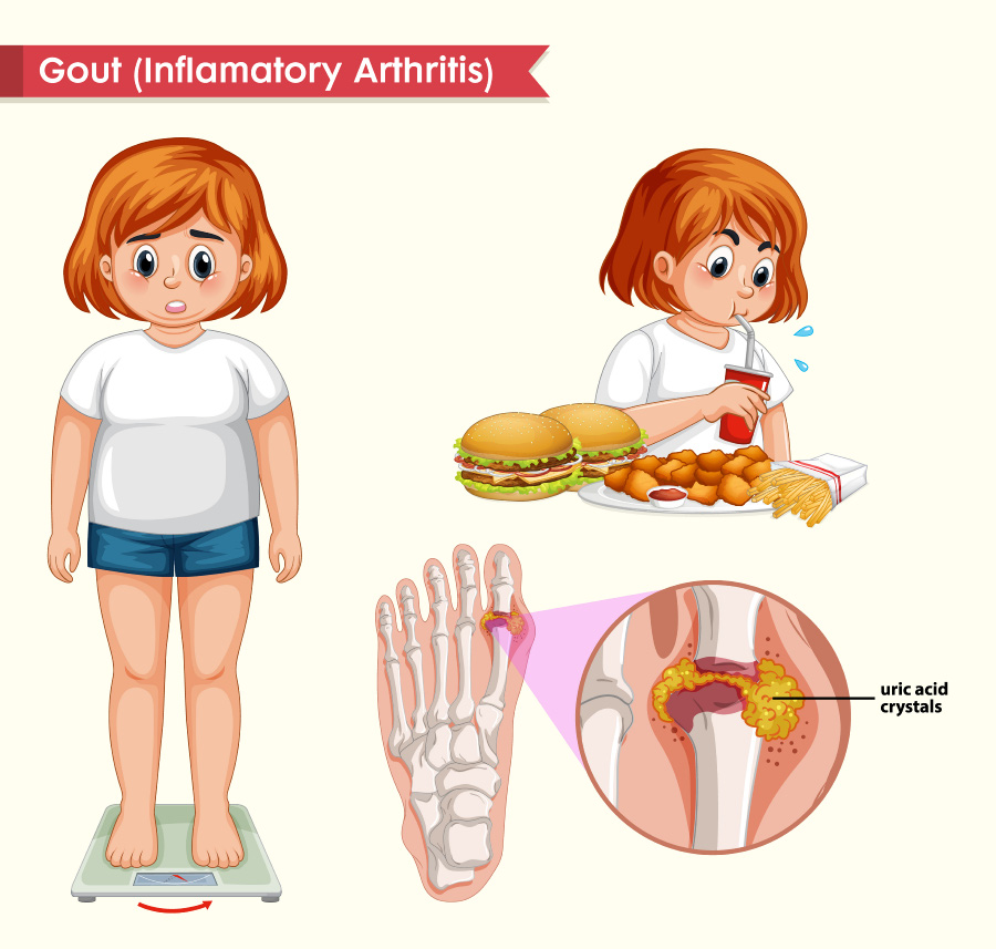 scientific-medical-illustration-gout-concept-900
