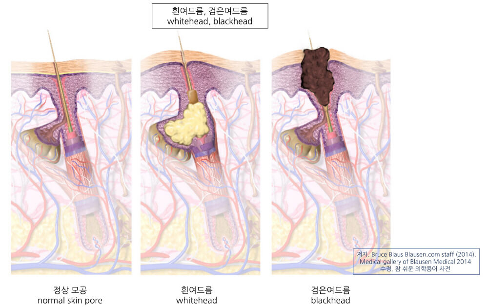 블랙헤드 화이트헤드가 만들어지는 이유 