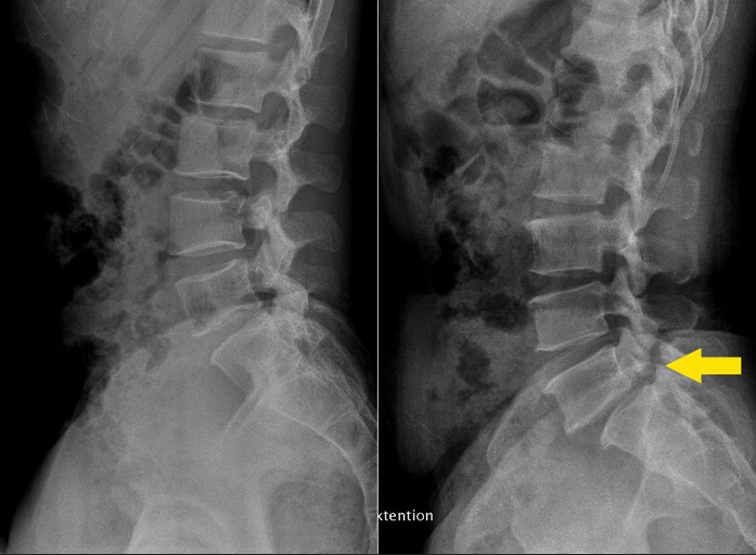 x-ray-척추
