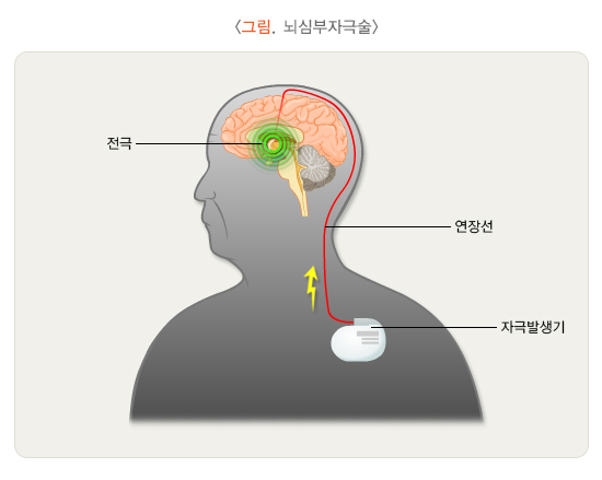 파킨슨병-약물-치료제-수술-요법-신약-후보