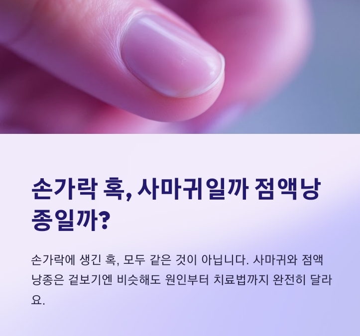 손가락 혹 요약 사진