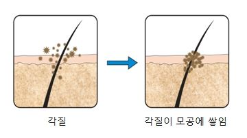 모공각화증이 생기는 과정