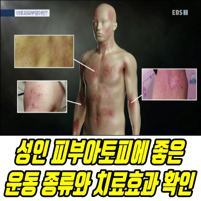  성인 아토피증상에 좋은 아토피운동 치료방법