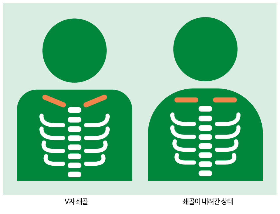 어깨결림을-부르는-쇄골-모양