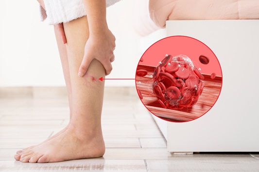  40대부터 주의, 다리 혈관이 울퉁불퉁? 하지정맥류 자가진단 & 치료약 종류