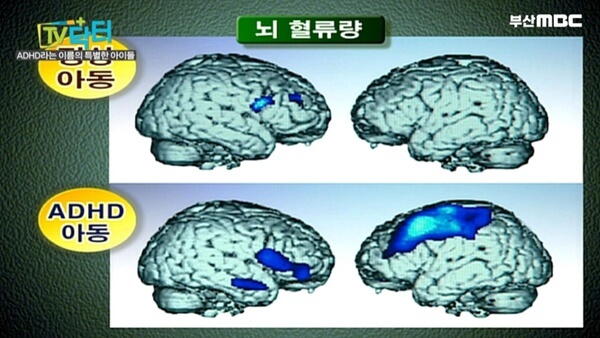 아동ADHD-의심-증상