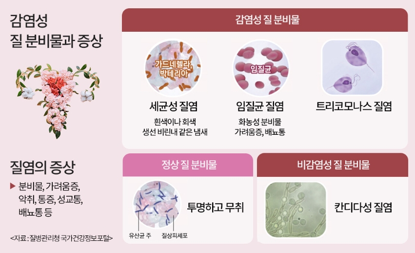질염의 증상 도표 이미지