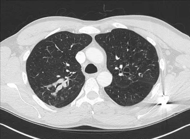 ABPA의 영상사진들 mucoid impaction
