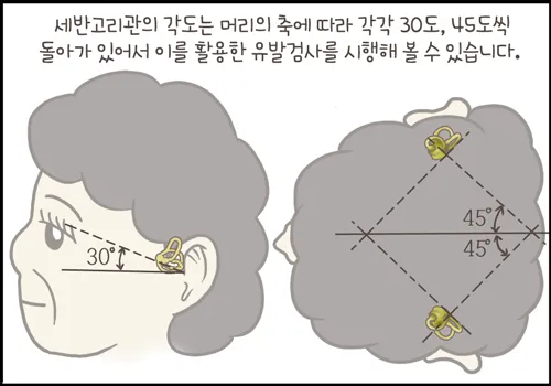 이석증 증상