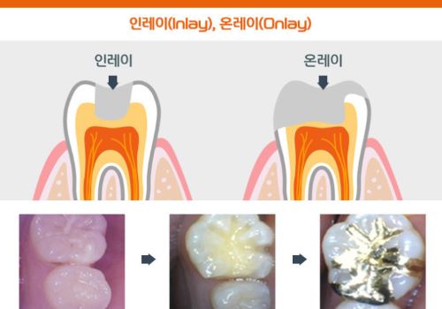 치아보존치료 사진