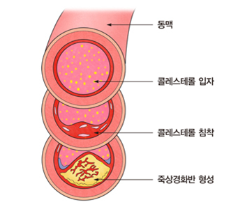 심근경색-원인