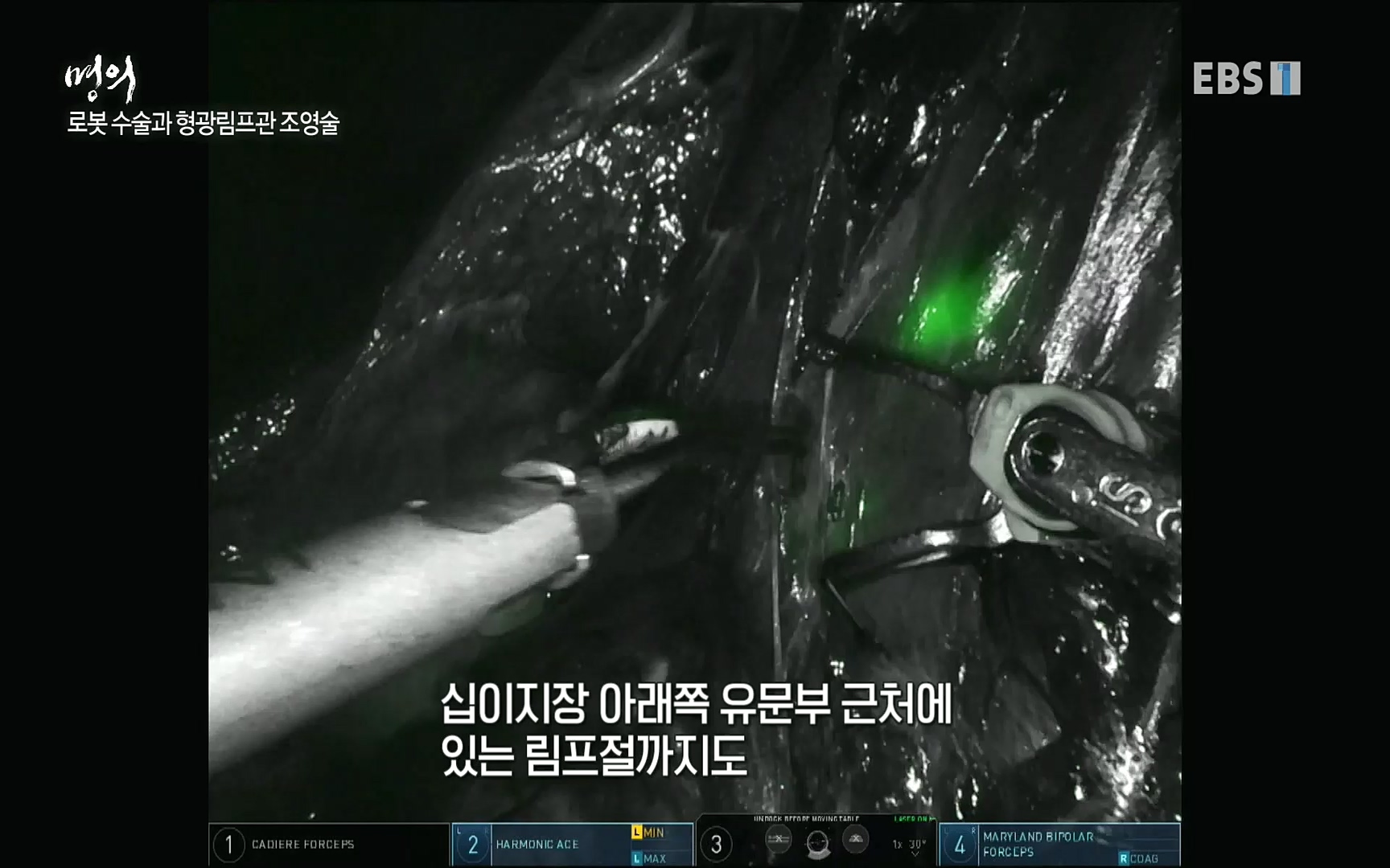 EBS 명의 헬스케어 - TV - 교육의 중심 EBS명의 15년, 위암 치료 이렇게 달라졌다!.mp4_20220809_203715.742.jpg