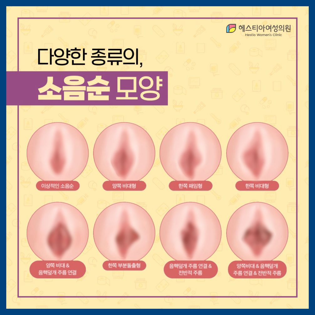 다양한 종류의 소음순 모양