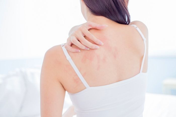 가을철 일교차로 악화되는 콜린성 두드러기 관리법