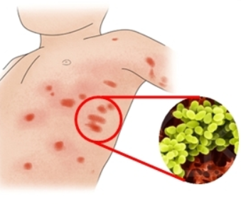 독성 쇼크 증후군 2