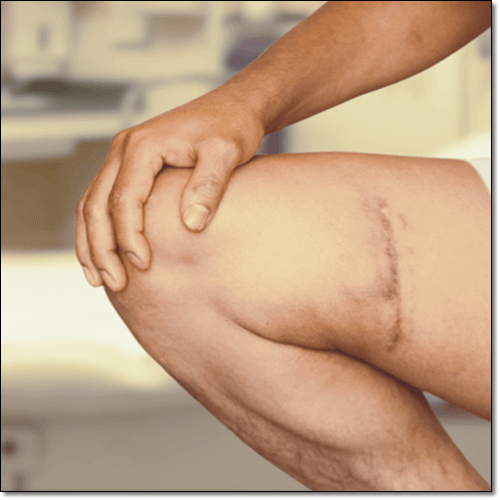고구마 잎 효능 뼈 건강&#44; 다리를 다친 남성