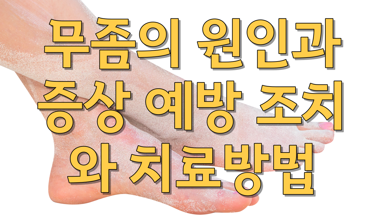  무좀의 원인과증상 예방 조치와 치료방법