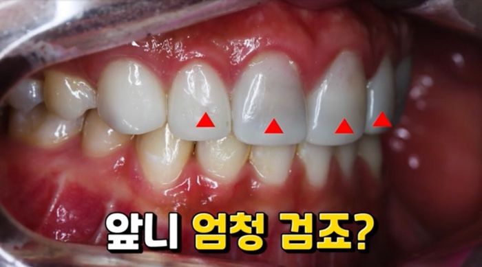  라미네이트 속에 충치 생김.jpg