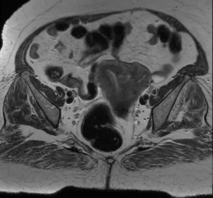 중격자궁의 MRI 소견