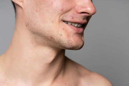 herpes-man-with-acne
