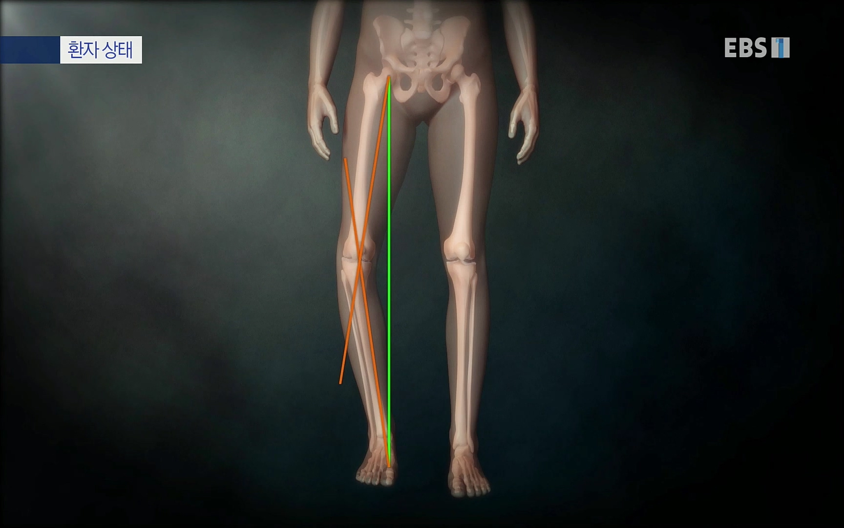 EBS 명의 헬스케어 - TV - 교육의 중심 EBS무릎 건강 프로젝트 2부 새 무릎으로 사는 법 .mp4_20220726_202342.044.jpg