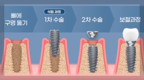 임플란트 시술 과정