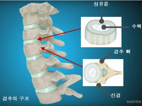  목디스크 증상 8가지 및 목디스크에 좋은 운동