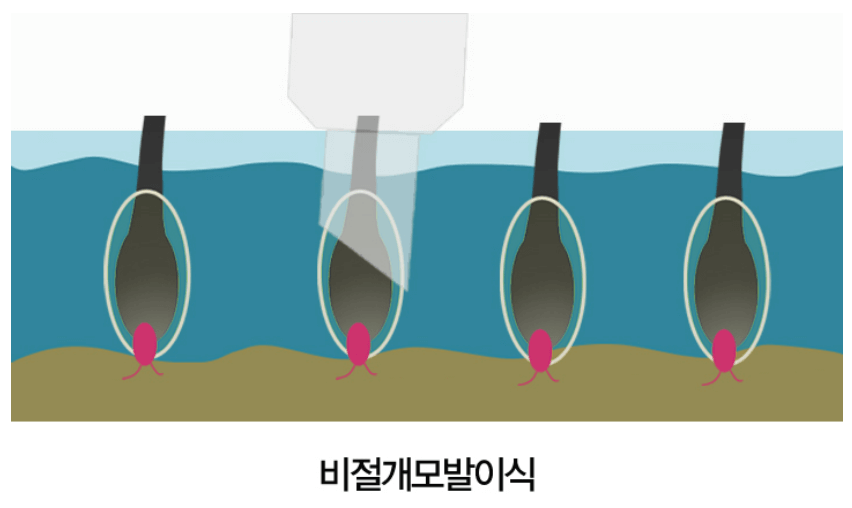 모발이식 비용 가격 모발이식 병원 추천