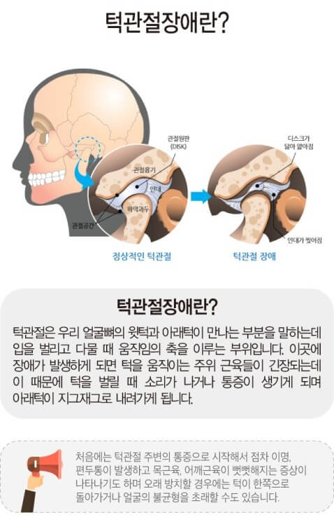 턱관절 장애 