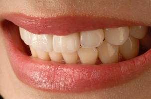 치아 신경치료 과정7
