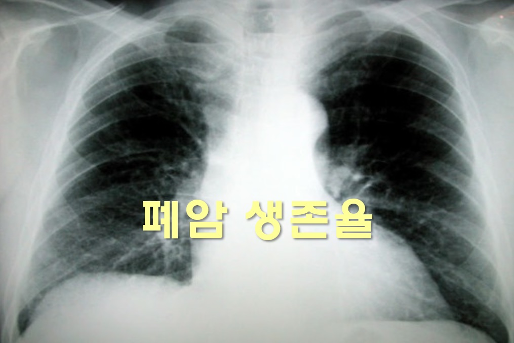  폐암 생존율과 폐암 사망률
