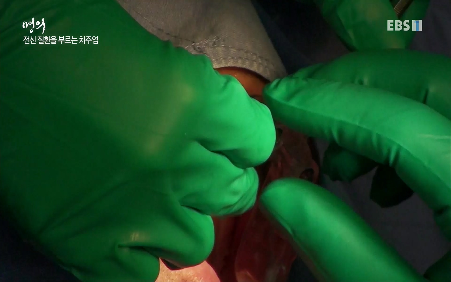 EBS 명의 헬스케어 - TV - 교육의 중심 EBS치주염이 코로나로 소홀해진 구강관리가 치아를 더 망가트리고 위험하게 만들며, 증상이 없기 때문에 특히 더 조심하고 치은염 단계에서 진행되지 않도록 예방해야한다 정의원 교수님과 치_20220505_151720.085.jpg