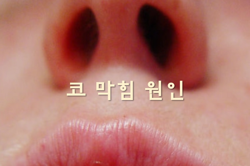  코 막힘 원인과 코 막힐 때 뚫는 방법