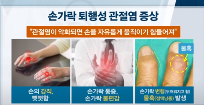 출처: 서울대병원TV(손가락 퇴행성 관절염 증상)