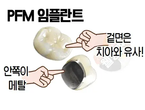 PFM임플란트-형태
