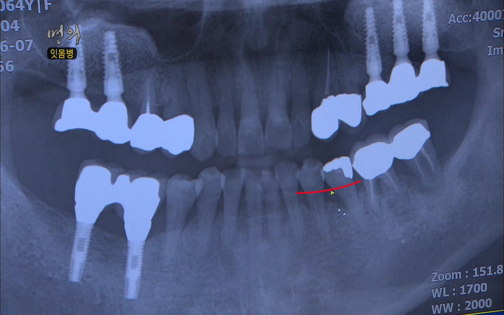 EBS 명의 헬스케어 - TV - 교육의 중심 EBS2015년 1월 16일 (금) 밤 9시 50분, EBS1.mp4_20220505_150413.086.jpg