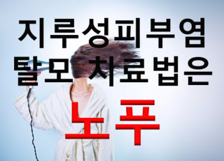  지루성두피염 탈모 치료방법은 "노푸"