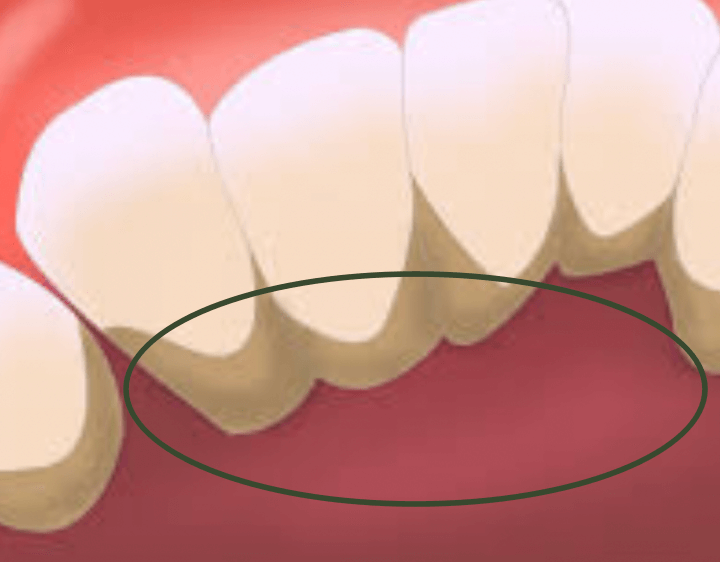 치아-밑-잇몸뼈