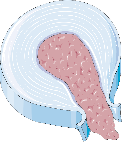 허리디스크 수술 or 보존적치료