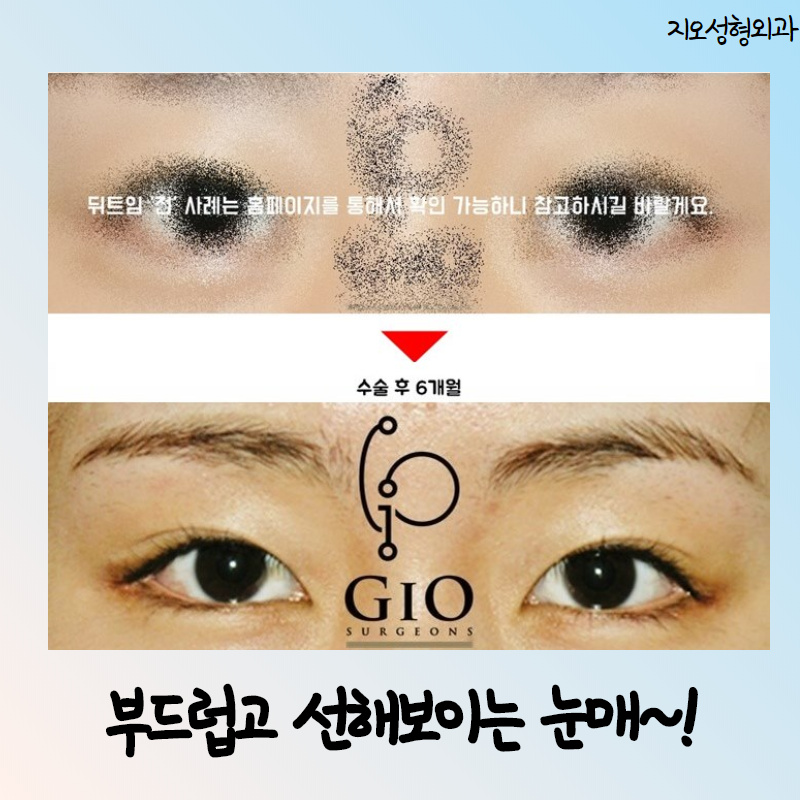  눈꼬리내리기 눈꼬리내리는수술 이거지 이거야