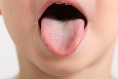 혀에 백태가 생기는 이유와 없애는법 