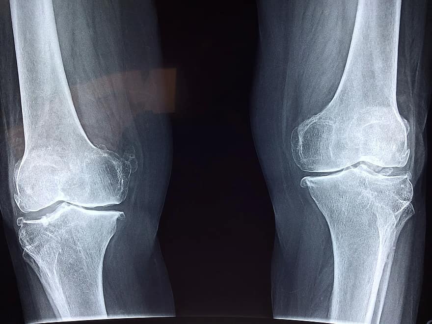 무릎관절염 x-ray