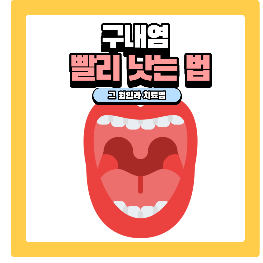  구내염 빨리 낫는 법과 원인 치료법 알아보기