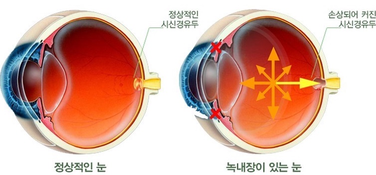  녹내장 원인 및 증상, 치료 방법, 녹내장에 좋은 음식