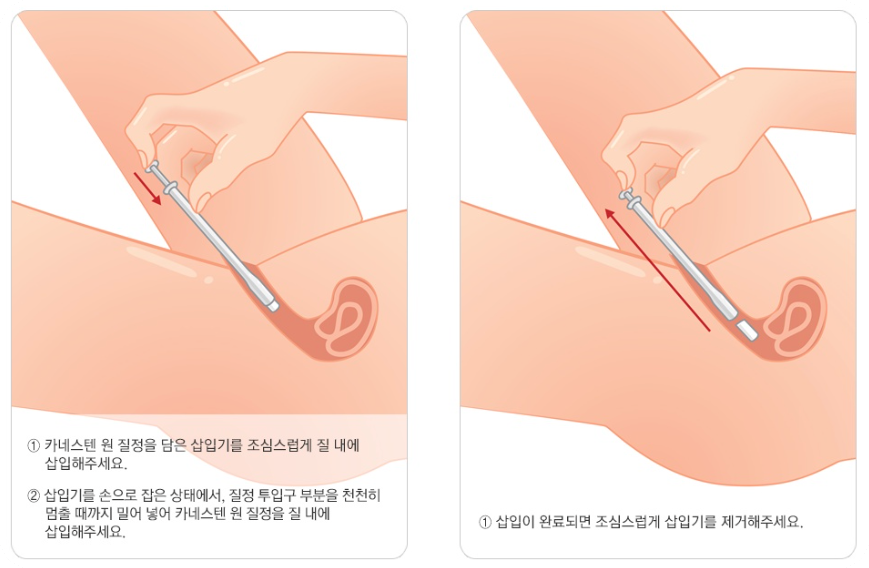 질염냄새치료6