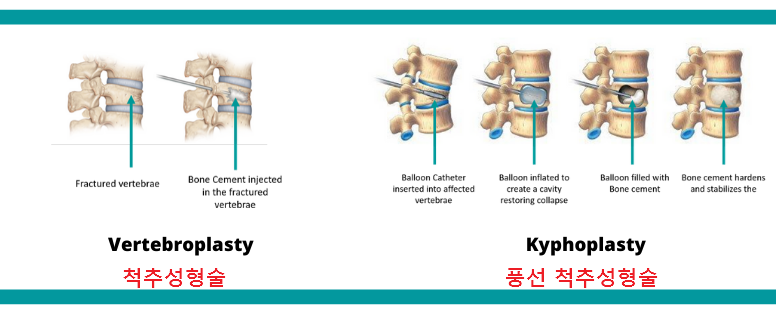 척추성형술 및 풍선 척추성형술의 비교 사진