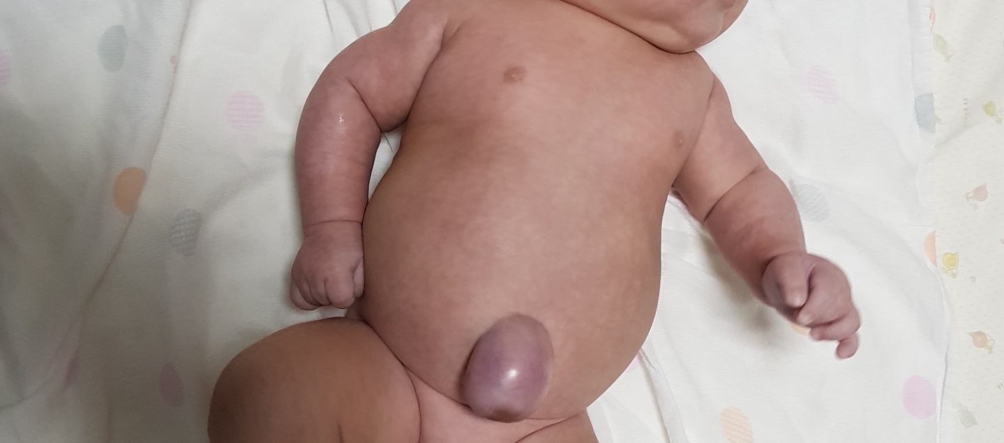 신생아 배꼽탈장원인 아기배꼽튀기 자연치유 경험담