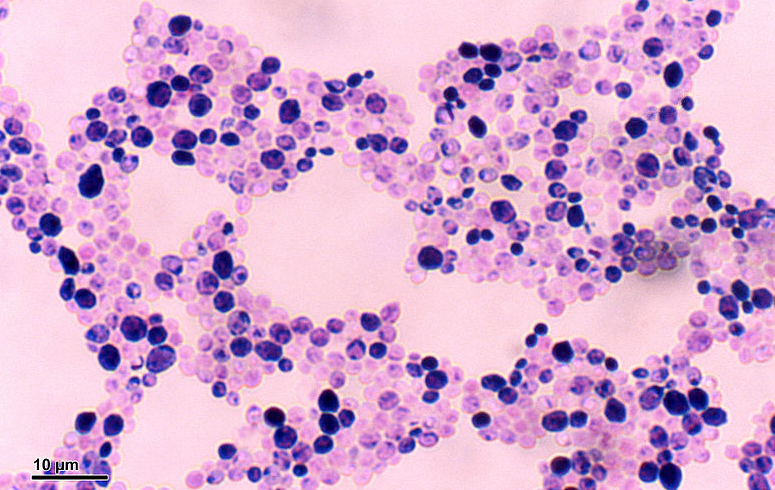  칸디다(Candida)증 원인과 증상 및 치료방법 예방법